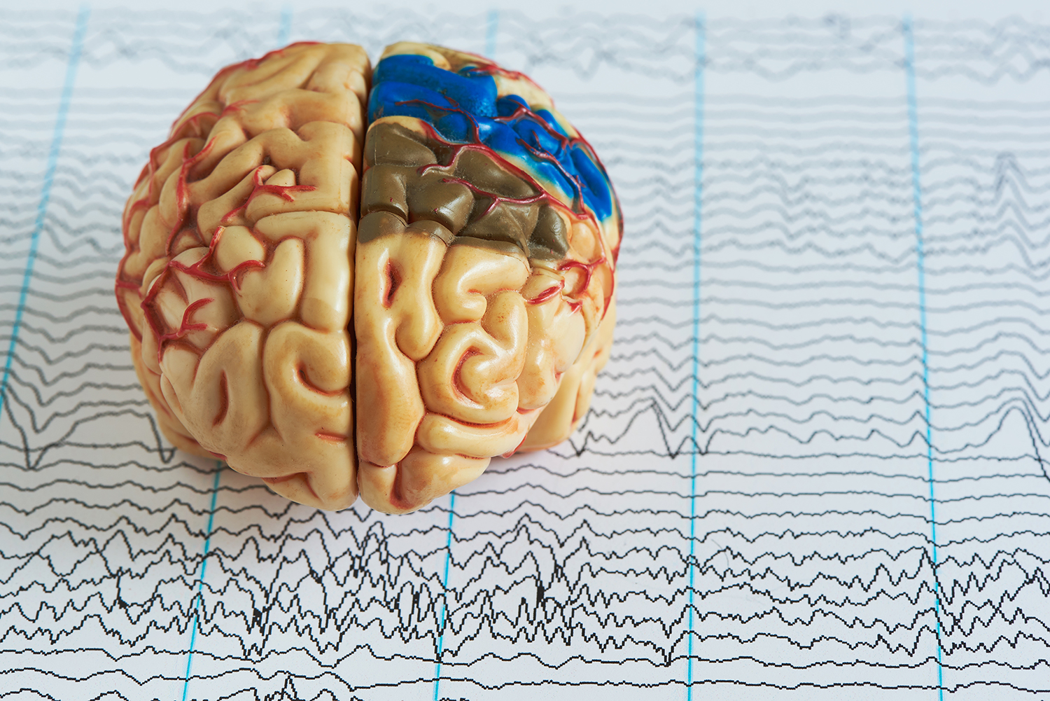 Brain-Health-EEG-Neurology